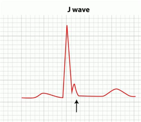 Ekg Last Lecture Flashcards Quizlet