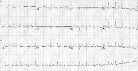 Supraventricular Tachycardia Svt Litfl Ecg Library Diagnosis 18480