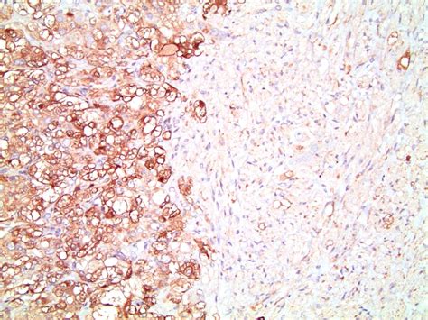 Pathology Outlines Composite Pheochromocytoma And Paraganglioma