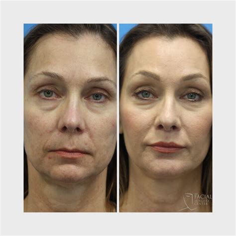 Endoscopic Browlift The Facial Surgery Center