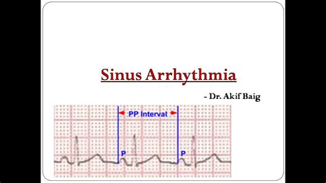 Ventriculophasic Sinus Arrhythmia Dr Akif Baig YouTube