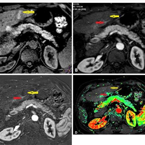 A 65 Year Old Male Patient With Liver Cirrhosis Underwent Download