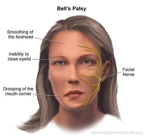 bells palsy diagnosed bells palsy  typically diagnosed