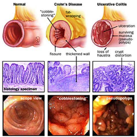 MD ☞ Ulcerative Colitis and Crohn's Disease. Nursing Study, Nursing Tips, Ulcerative Colitis ...