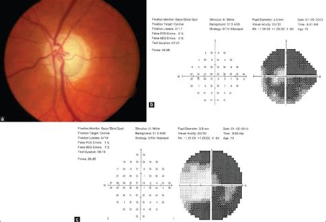 Management Decisions And Surgical Considerations In Severe Glaucoma