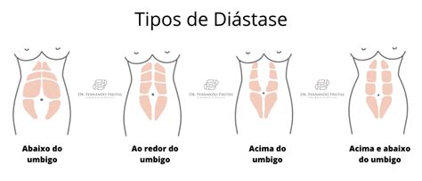 Di Stase Abdominal O Que E Como Tratar Dr Fernando Freitas