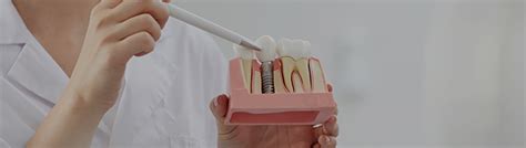 Dental Implants Gosford Central Coast Mann St Dental