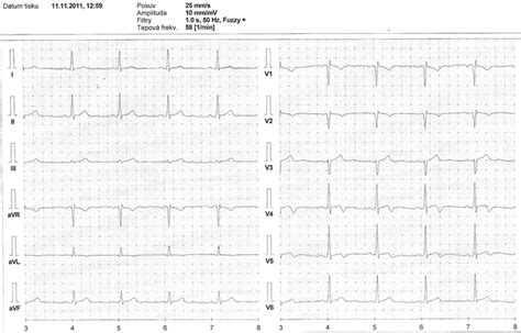 EKG z praxe 11 Medicína nemoci studium na 1 LF UK