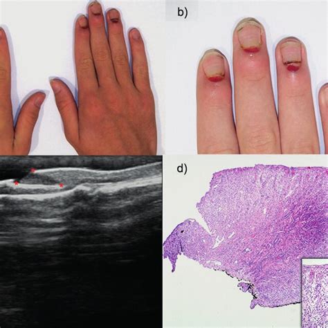 Pdf Multiple Eruptive Pyogenic Granulomas On The Proximal Nail Folds