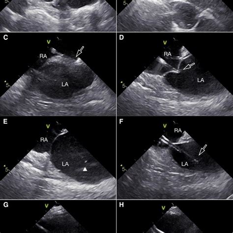 Ice Images Ah Taken During The Transseptal Puncture The Fr