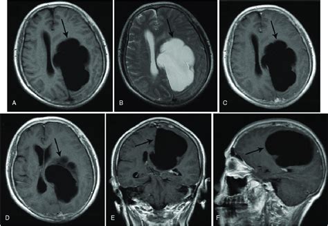 Magnetic Resonance Image Shows An Arachnoid Cyst In The Left Parietal Download Scientific