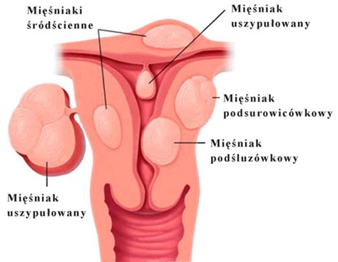 Rodzaje Mi Niak W Macicy Leczymymiesniaki Pl