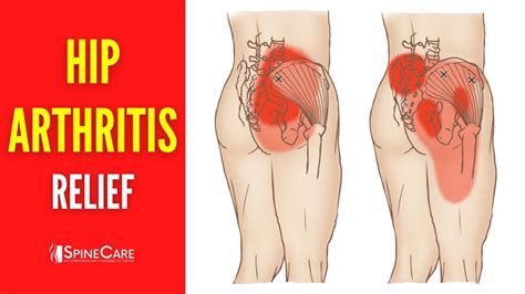 How To Relieve Hip Arthritis Pain In Seconds Artofit