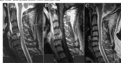 Figure 1 From Successful Treatment Of Cervical Spinal Epidural Abscess