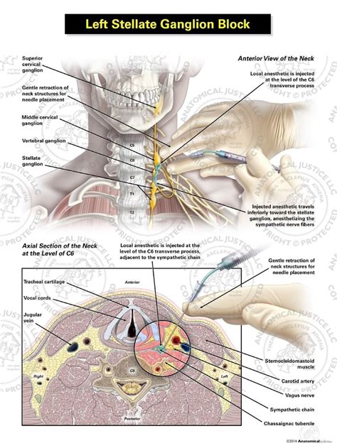 Female Left Axial Stellate Ganglion Block