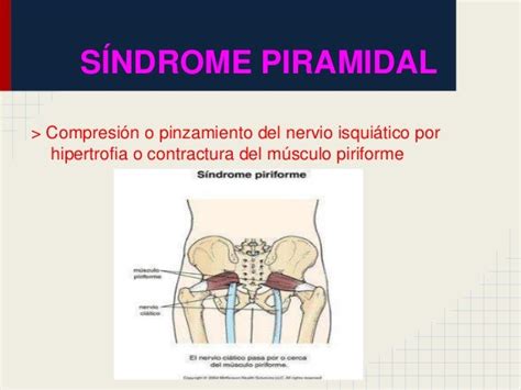 Sindrome piramidal , musculo piramidal