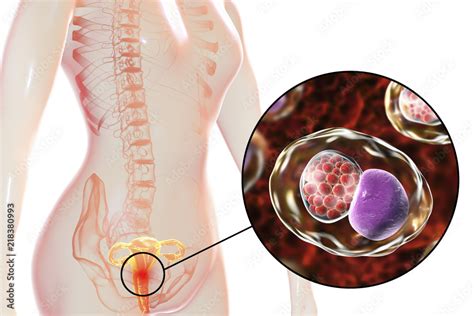 Female Chlamydiosis Medical Concept 3D Illustration Showing Close Up