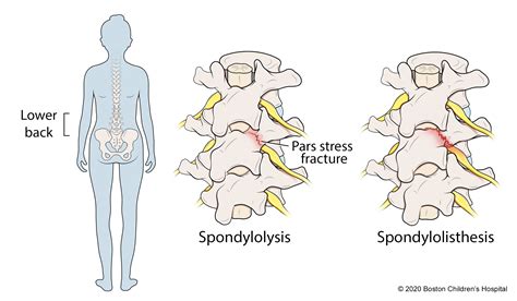 Spondylolysis And Spondylolisthesis Boston Childrens Hospital Ob欧宝
