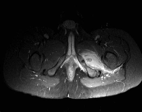 Mri Axial T1 Fat Sat Post Gadolinium Download Scientific Diagram