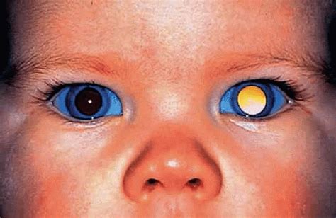 Retinoblastoma And Simulating Lesions Ento Key