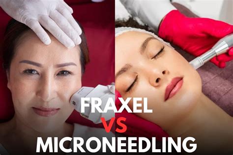 Fraxel Vs Microneedling Fitness Beauty Art