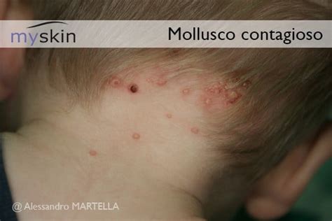 Molluschi Contagiosi Myskin