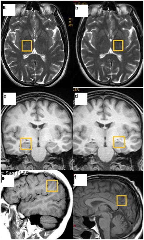 Voxel Placement In The Different Brain Regions The Thalamus A B