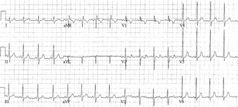 Pre Excitation Syndromes • Litfl • Ecg Library Diagnosis