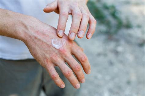 Vtama Cream For Psoriasis Easy Drug Card