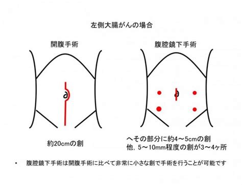 大腸がんに対する腹腔鏡下手術 独立行政法人 国立病院機構 函館医療センター