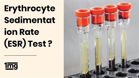 Erythrocyte Sedimentation Rate Esr Off