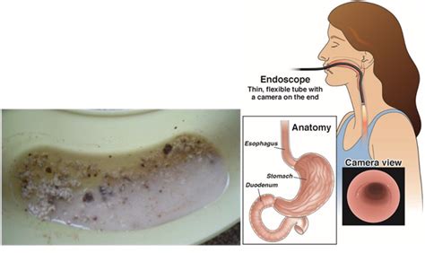 Coffee Ground Emesis