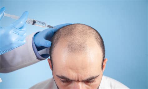 Choosing The Right Hair Transplantation Clinic In India A