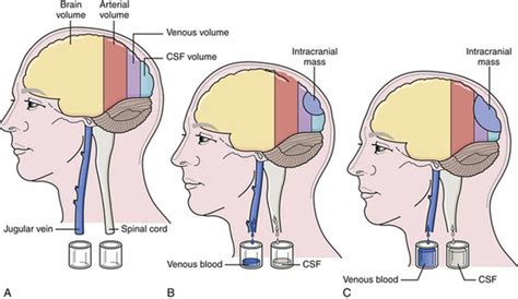 Intracranial Pressure High Intracranial Pressure Causes Symptoms And Treatment