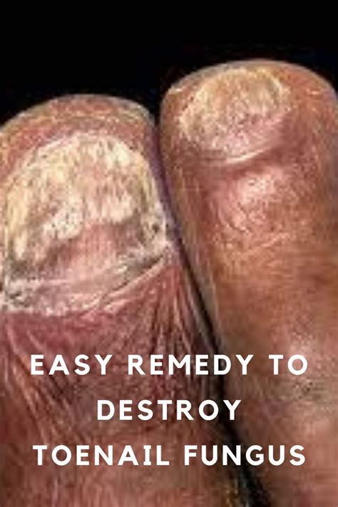 People Go Crazy For This Remedy To Fix Nail Fungus Artofit