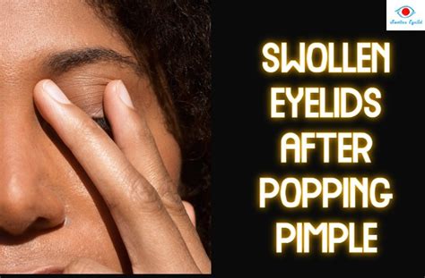 Can a Pimple Cause your Eye to Swell? - Popping a Pimple - Swollen Eyelid