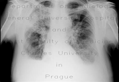 Radiology Case Pneumonia Pleural Effusion