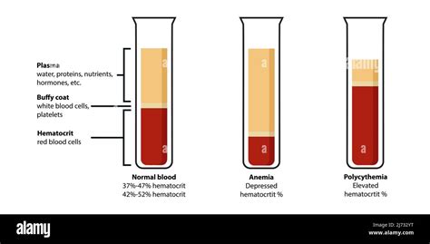 Сorrelation Entre los glóbulos rojos eritrocitos los glóbulos