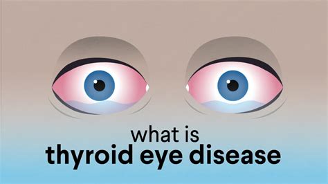 Thyroid Eye Disease Symptoms Causes And Its Treatment