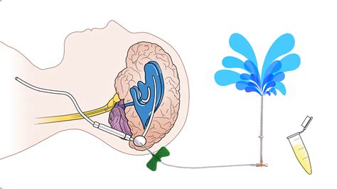 VP shunt malfunction - First10EM