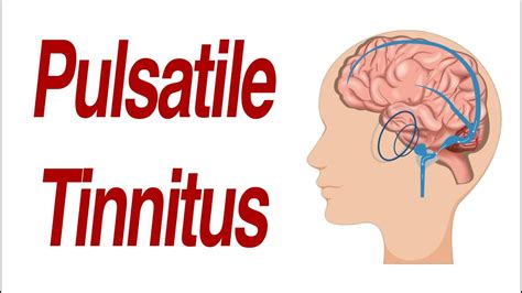 Pulsatile Tinnitus: Causes, Symptoms, and Treatment - Tinnitus
