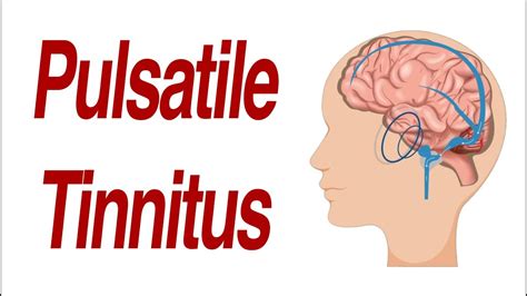 Pulsatile Tinnitus Causes Symptoms And Treatment Tinnitus