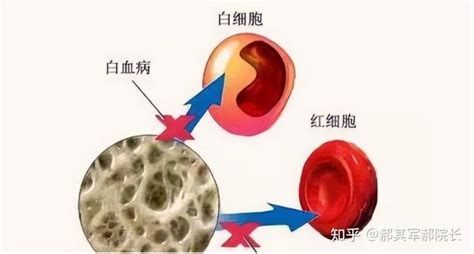 贫血！再生障碍性贫血与缺铁性贫血之间有何不同？ 知乎