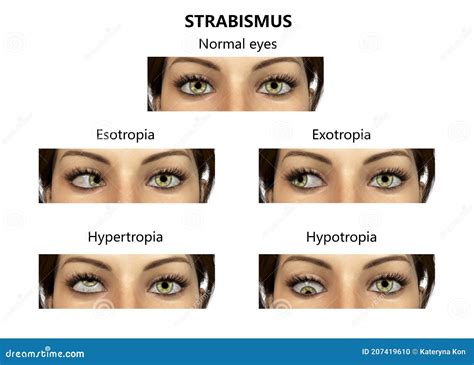 Strabismus Eyes Deviation Illustration CartoonDealer 207420675