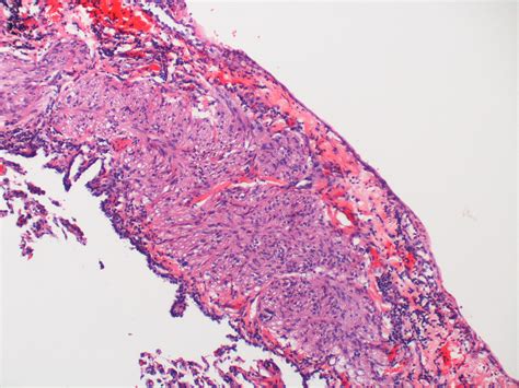 Lymphangioleiomyomatosis (LAM) Case 126 | Linear subpleural … | Flickr