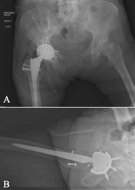 Immediate Anteroposterior A And Lateral B Postoperative Radiographs