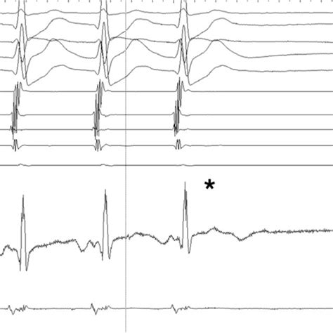 Surface Electrocardiogram ECG And Intra Cardiac Electrogram IECG