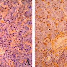 Immunohistochemical Analysis Of Hbsag And Hbcag In Liver Tissues Of