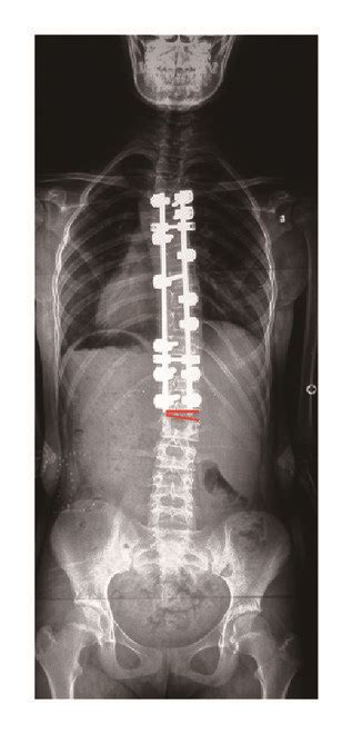 A A 13 Year Old Girl With Lenke 1a Curve L2 Was Ssv Risser Grade Download Scientific