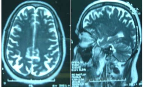 MRI Findings Of Cerebral Vasculitis Including Multiple Supratentorial